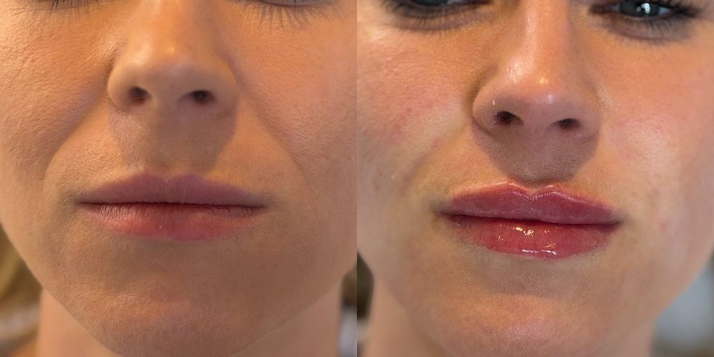 Dermal filler - image update